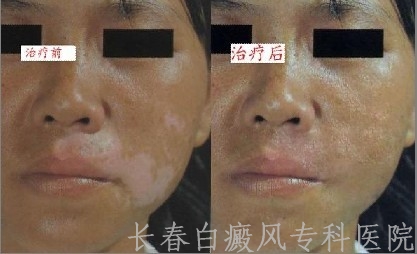 如何预防脸上出现白癜风 如何预防脸上出现白癜风