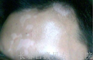 白癜风扩散症状有什么表现 白癜风扩散症状有什么表现
