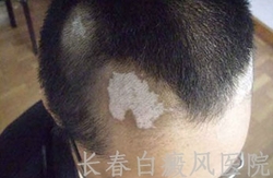 白癜风的症状如何 白癜风的症状如何