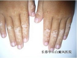 白癜风的基本常识 白癜风的基本常识