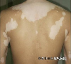 白癜风晚期有什么危害 白癜风晚期有什么危害