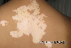 白癜风能否快速治愈 白癜风能否快速治愈