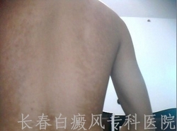 白癜风如何治疗最好 白癜风如何治疗最好