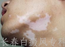白癜风对患者的危害有哪些 白癜风对患者的危害有哪些