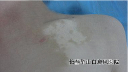 白癜风哪里治的好 白癜风哪里治的好