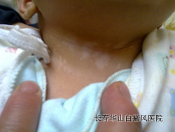 小孩患白癜风怎么治 小孩患白癜风怎么治