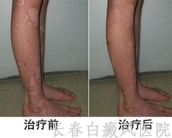 预防白癜风复发的方法有哪些 预防白癜风复发的方法有哪些