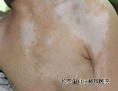 得了白癜风能治愈吗 得了白癜风能治愈吗