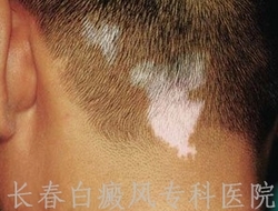 得了白癜风有什么危害 得了白癜风有什么危害