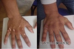 创伤性白癜风能治好吗 创伤性白癜风能治好吗