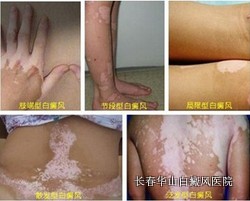 白癜风的发病有什么特点 白癜风的发病有什么特点