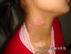 白癜风的发病与什么原因有关 白癜风的发病与什么原因有关