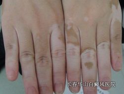 白癜风的白斑为什么扩散 白癜风的白斑为什么扩散