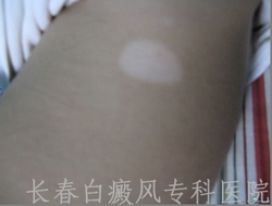 诊断自检白斑是不是白癜风 诊断自检白斑是不是白癜风