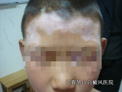 白癜风的病情为什么会加重 白癜风的病情为什么会加重