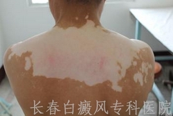 女性白癜风患者应注意什么 女性白癜风患者应注意什么