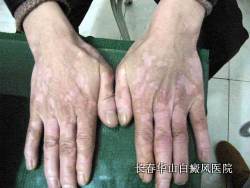 白癜风长期不能治愈的原因 白癜风长期不能治愈的原因