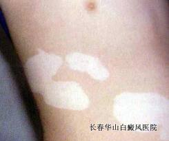 白癜风的白斑怎么判断 白癜风的白斑怎么判断