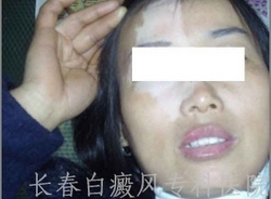 为什么面上易得白癜风 为什么面上易得白癜风