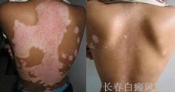 治愈白癜风会复发吗 治愈白癜风会复发吗