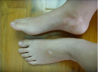 白癜风发病初期的现象